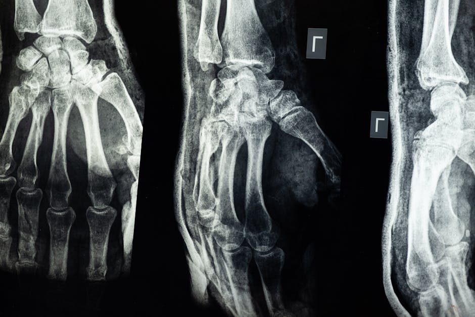 40% of adults worldwide suffer from osteopenia