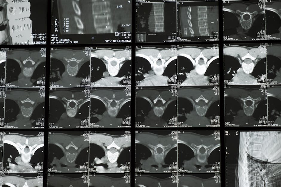 Calcium and D Supplements Fail to Prevent 1 in 10 Fractures