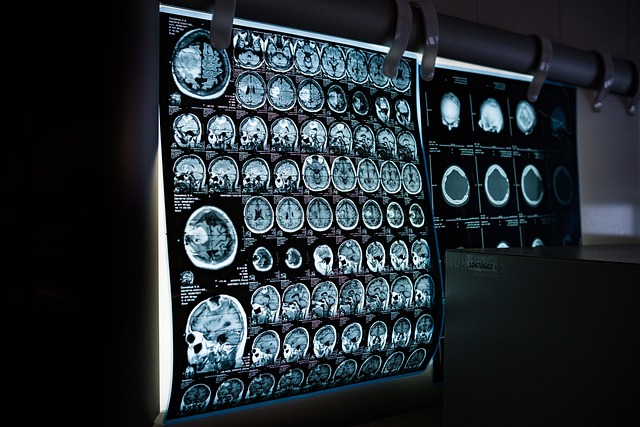 New Brain Scan Detects Alzheimer's 5 Years Earlier - VirentaNews