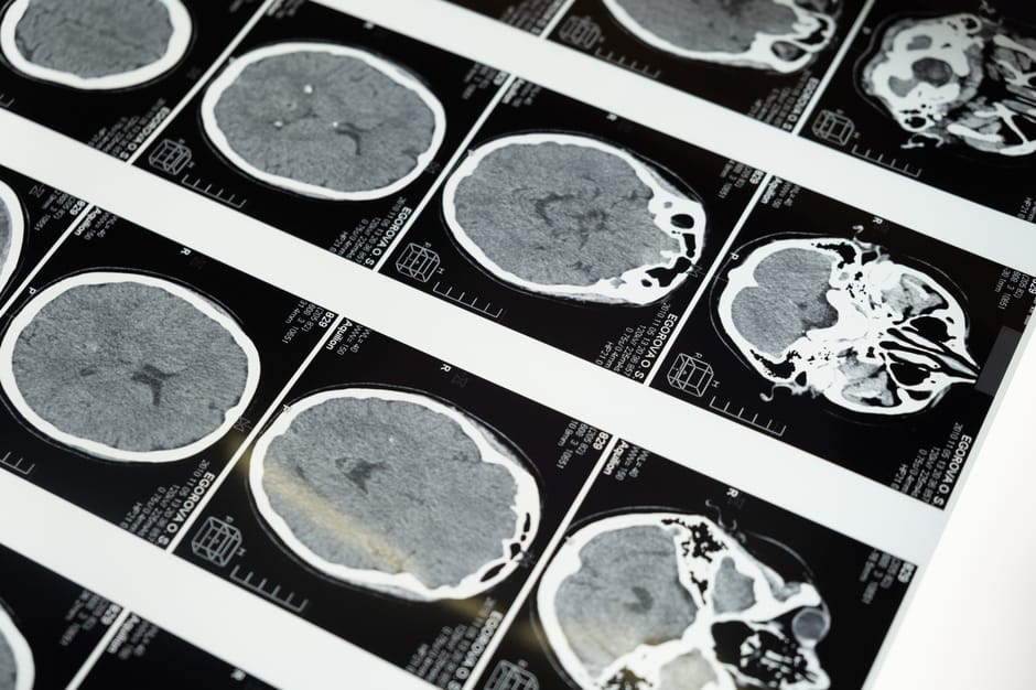 Ultra-Processed Foods Linked to Cognitive Decline, Study Reveals