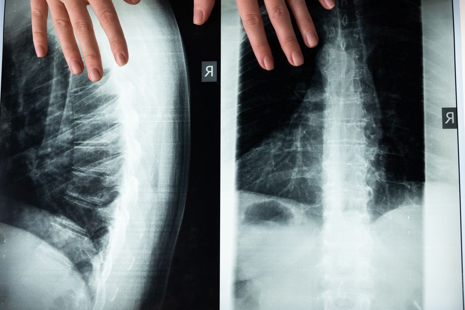 What drives lower-back nerve pain? Genetic clues could reshape stenosis care - VirentaNews