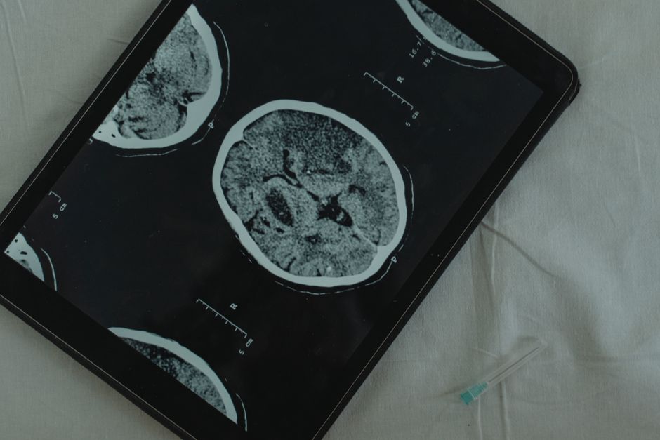 Why Brain Aneurysms Rupture: New Study Reveals Key Cell Types